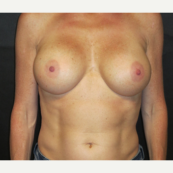 35-44 year old woman treated with Breast Implant Revision after 3367015