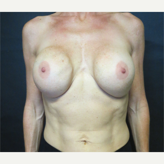 35-44 year old woman treated with Breast Implant Revision before 3367015