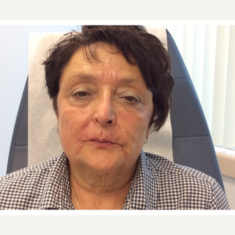 65-74 year old woman treated with Botox, Juvederm, ProFractional Laser and BBL within 2 years time before 3056115