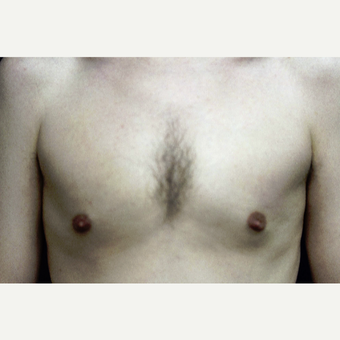 31 year old man treated for gynecomastia with liposuction after 3419132