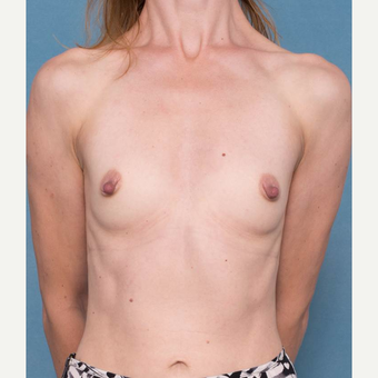 35-44 year old woman treated with Breast Augmentation before 3072463