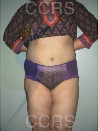 45 yr. old female. Tummy Tuck with VASER lipo for body contouring 1042662