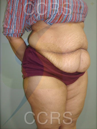 45 yr. old female. Tummy Tuck with VASER lipo for body contouring before 1042662