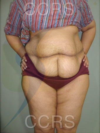45 yr. old female. Tummy Tuck with VASER lipo for body contouring 1042662