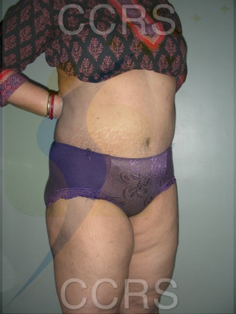 45 yr. old female. Tummy Tuck with VASER lipo for body contouring after 1042662