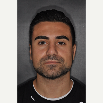 18-24 year old man treated with Septoplasty 6 weeks post-op after 3500158