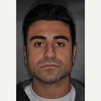 18-24 year old man treated with Septoplasty 6 weeks post-op before 3500158
