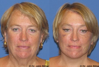 Laser Skin Resurfacing before 1156583