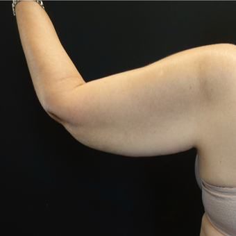 45-54 year old woman treated with Arm Lift before 3730393