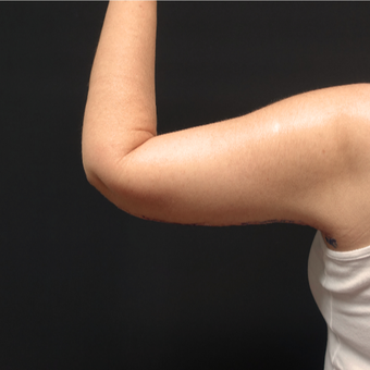 45-54 year old woman treated with Arm Lift after 3730393
