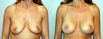Breast Implants before 1181611