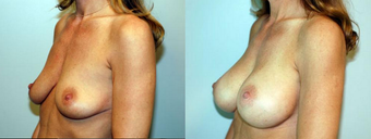 Breast Implants after 1181611