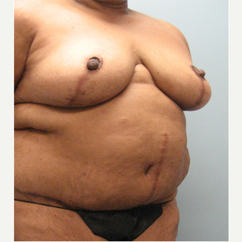 71 year old woman treated with Body Lift after 3680304