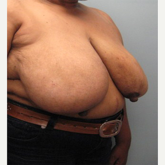71 year old woman treated with Body Lift before 3680304