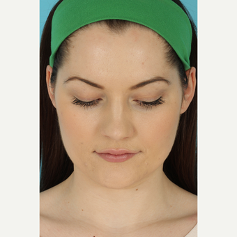 25-34 year old woman treated with Rhinoplasty before 3691087