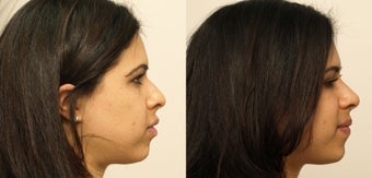 Rhinoplasty without surgery before 1020540