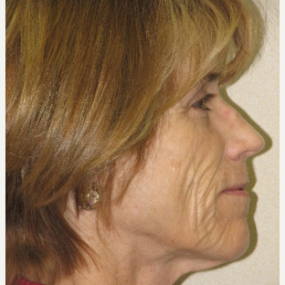 Mature woman not wanting a surgical facelift using combination fillers and lasers before 3137204