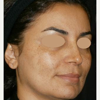 35-44 year old woman treated with IPL before 3153420
