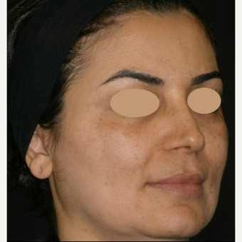 35-44 year old woman treated with IPL after 3153420