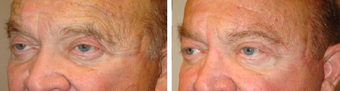 Male Eyebrow Lift before 1167825