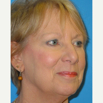 65-74 year old woman treated with Eyelid Surgery after 3570761