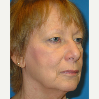 65-74 year old woman treated with Eyelid Surgery before 3570761