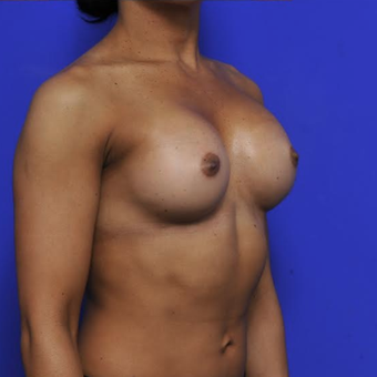 41 year old woman treated with Breast Augmentation after 3840339