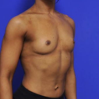 41 year old woman treated with Breast Augmentation before 3840339