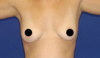 30 yo female desires larger natural breasts before 1129984