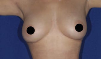 30 yo female desires larger natural breasts after 1129984