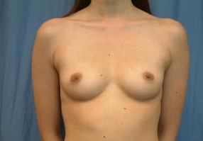 Breast Implants before 1365380
