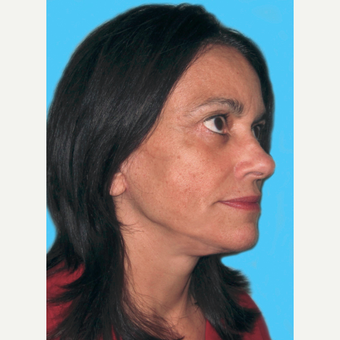 Facelift after 3824976