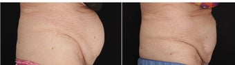 80-year-old woman had CoolSculpting for the protruding fat in the mid section of the abdomen. before 1088327