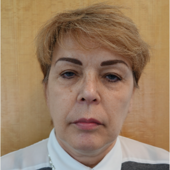 45-54 year old woman treated with thread lift to the face and neck area before 3031374