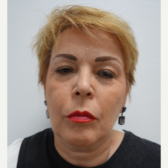 45-54 year old woman treated with thread lift to the face and neck area after 3031374