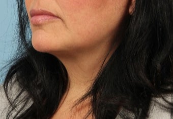 45-54 year old woman treated with Lip Implants after 3615551