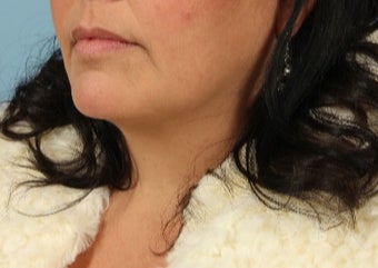 45-54 year old woman treated with Lip Implants before 3615551