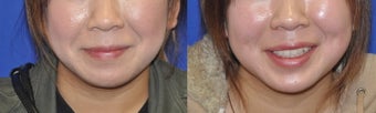 Dimple Creation Surgery before 252845