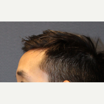 28 year old male treated with Forehead Reduction after 3289086