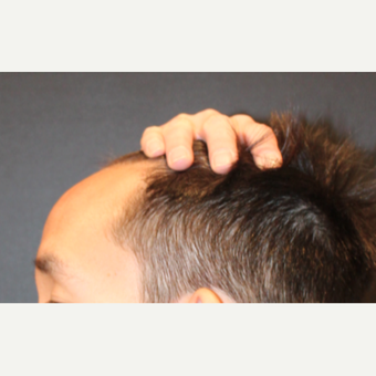 28 year old male treated with Forehead Reduction before 3289086