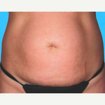 Tummy Tuck before 3810836