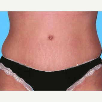 Tummy Tuck after 3810836