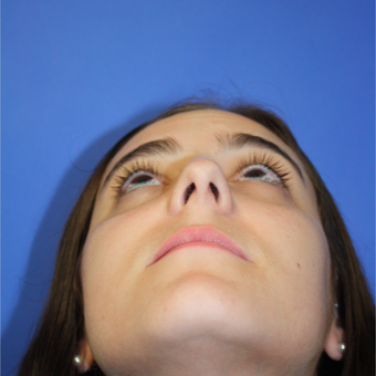 18-24 year old woman treated with Rhinoplasty before 3400157