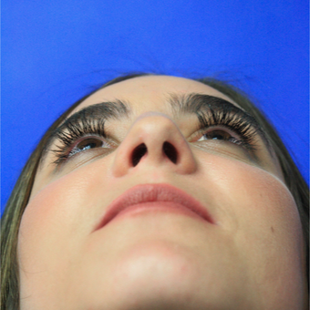 18-24 year old woman treated with Rhinoplasty after 3400157