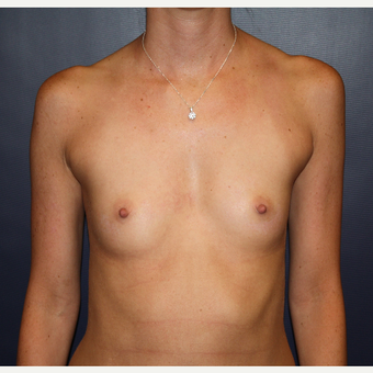 25-34 year old woman treated with Breast Augmentation before 2725607