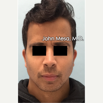 18-24 year old man treated with Buccal Fat Removal after 3266802