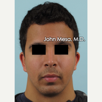 18-24 year old man treated with Buccal Fat Removal before 3266802