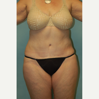 58 year old woman, 5'6", 188 lbs. four months after lipoabdominoplasty after 3771599
