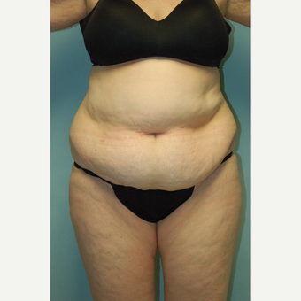58 year old woman, 5'6", 188 lbs. four months after lipoabdominoplasty before 3771599