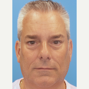 52 Year old Male treated with Botox and Restylane after 3685104